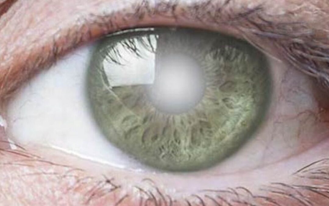 The Truth About Cataracts