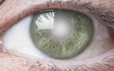 The Truth About Cataracts